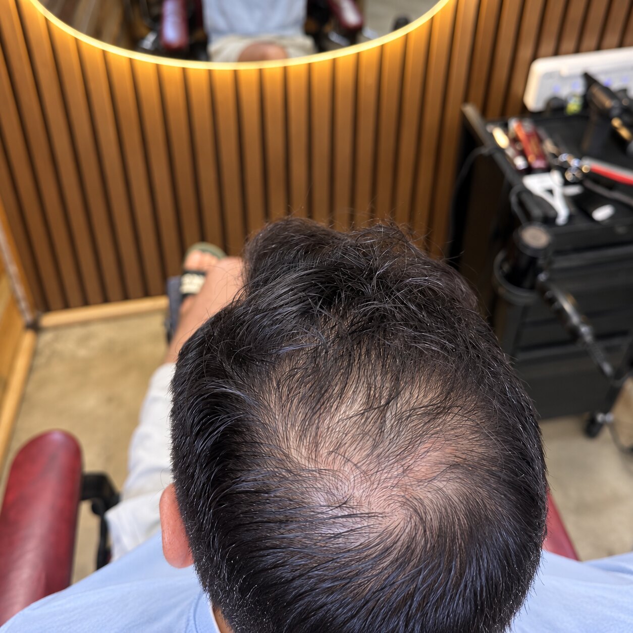 Common Causes of Hair Loss: What You Should Know